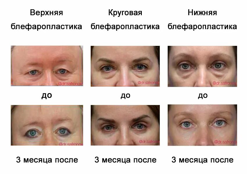 Нижняя блефаропластика по дням фото отзывы Блефаропластика нижних век по дням - Арт Минск.ру