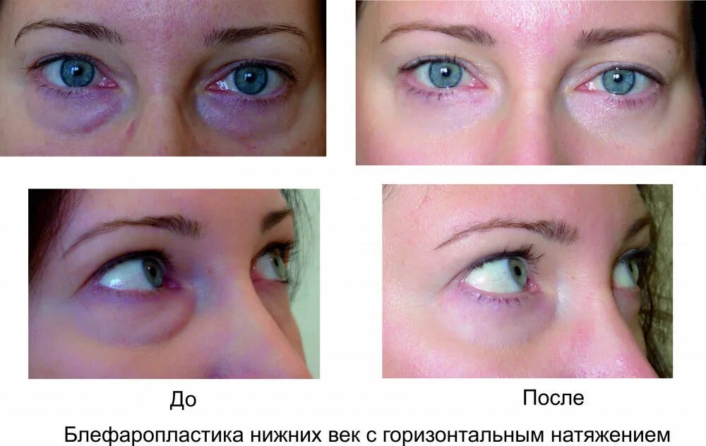Нижняя блефаропластика по дням фото отзывы Блефаропластика верхних, нижних век. Фото до и после процедуры