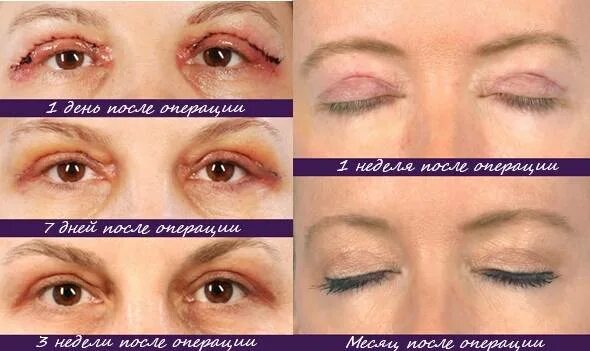 Нижняя блефаропластика по дням фото отзывы Блефаропластика - фото, отзывы и цены