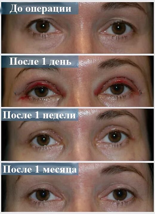 Нижняя блефаропластика реабилитация по дням фото Блефаропластика: ЗА и ПРОТИВ, отзывы, фото