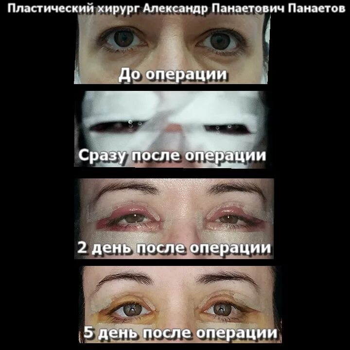 Нижняя блефаропластика реабилитация по дням фото Блефаропластика: верхняя, нижняя и круговая ПАНАЕТОВ Александр Панаетович