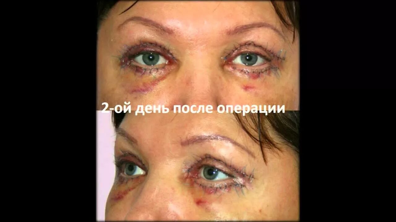Нижняя блефаропластика реабилитация по дням фото Круговая блефаропластика реабилитационный период - YouTube