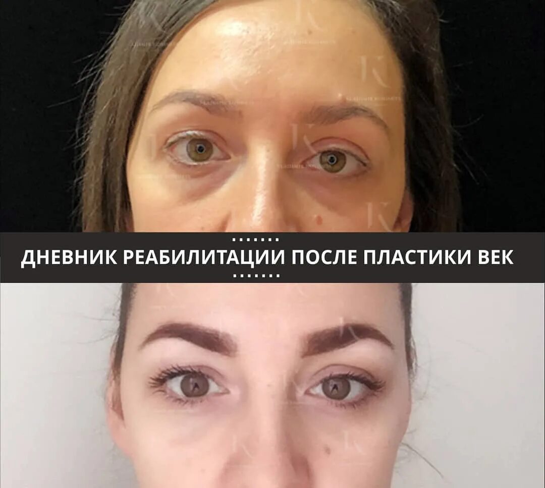 Нижняя блефаропластика реабилитация по дням фото Процесс реабилитации после блефаропластики способ