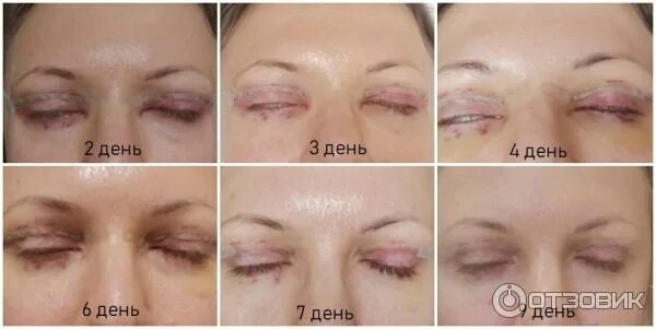 Нижняя блефаропластика реабилитация по дням фото Отзыв о Блефаропластика Круговая операция, реабилитация в динамике по дням, фото