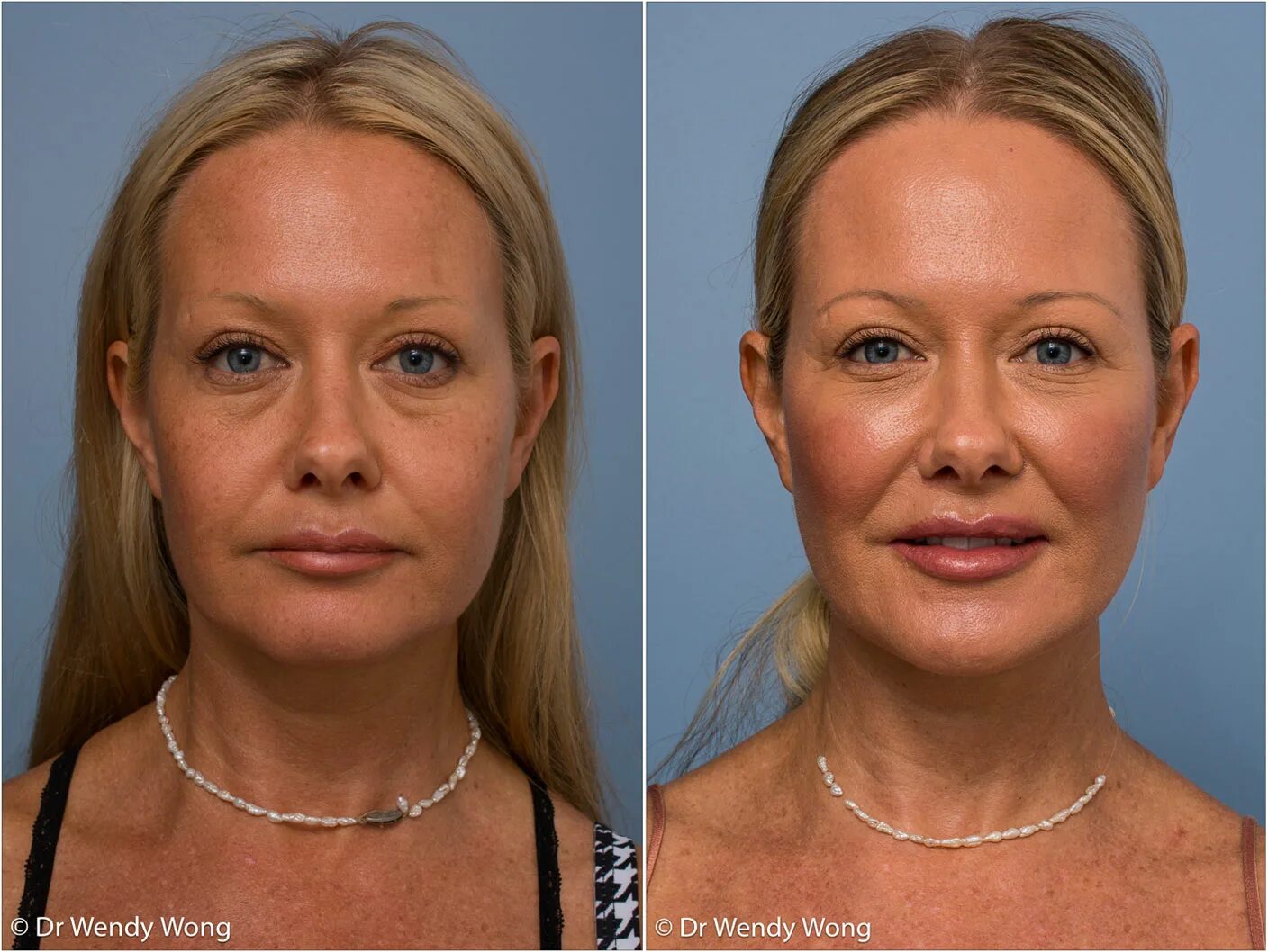 Нижняя часть лица фото Filler in the cheeks before and after - lower face fillers before and after - ww