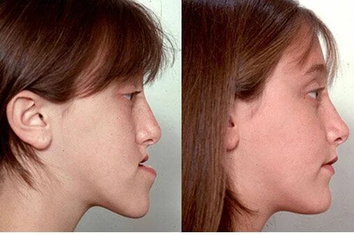 Нижняя челюсть фото Pin on Maxillofacial Orthognathic Surgery