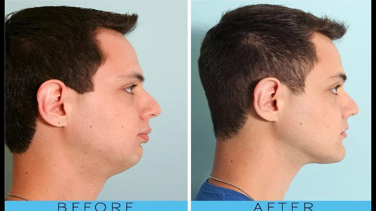 Нижняя челюсть фото how to get a good jawline and cheekbones - YouTube