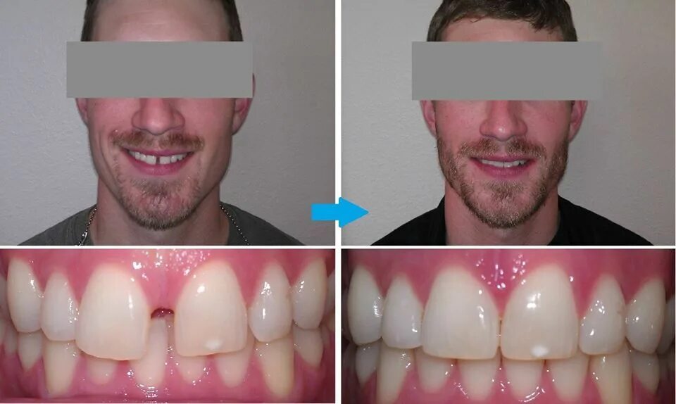 Нижняя десна фото #StraighenTeeth Without #Braces #OrthoSnapNewYork #Manhattan #Brooklyn *.***.***