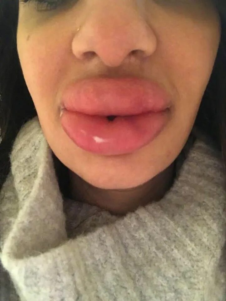 Нижняя губа опухла фото Dentist left with 'huge blue lumps' in her swollen lips after botched fillers - 