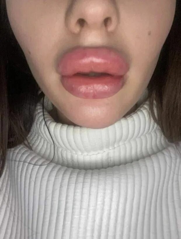 Нижняя губа опухла фото Pin on larissa limitada