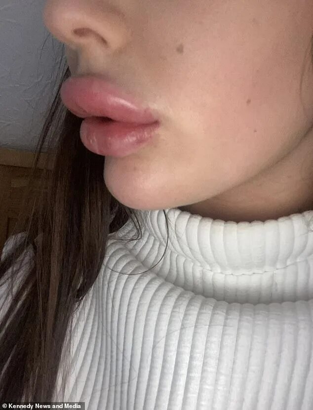 Нижняя губа опухла фото Flight attendant, 21, claims that a £ 100 filler treatment left her lips so swol