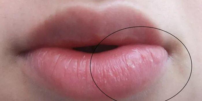 Нижняя губа опухла фото What Does A Swollen Upper Lip Mean nda.or.ug