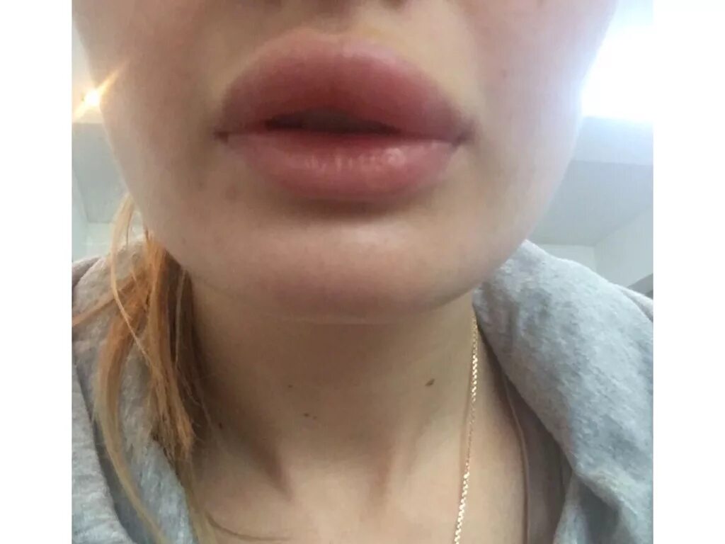 Нижняя губа опухла фото Опухла верхняя губа после Принцесс волюм при ОРВИ