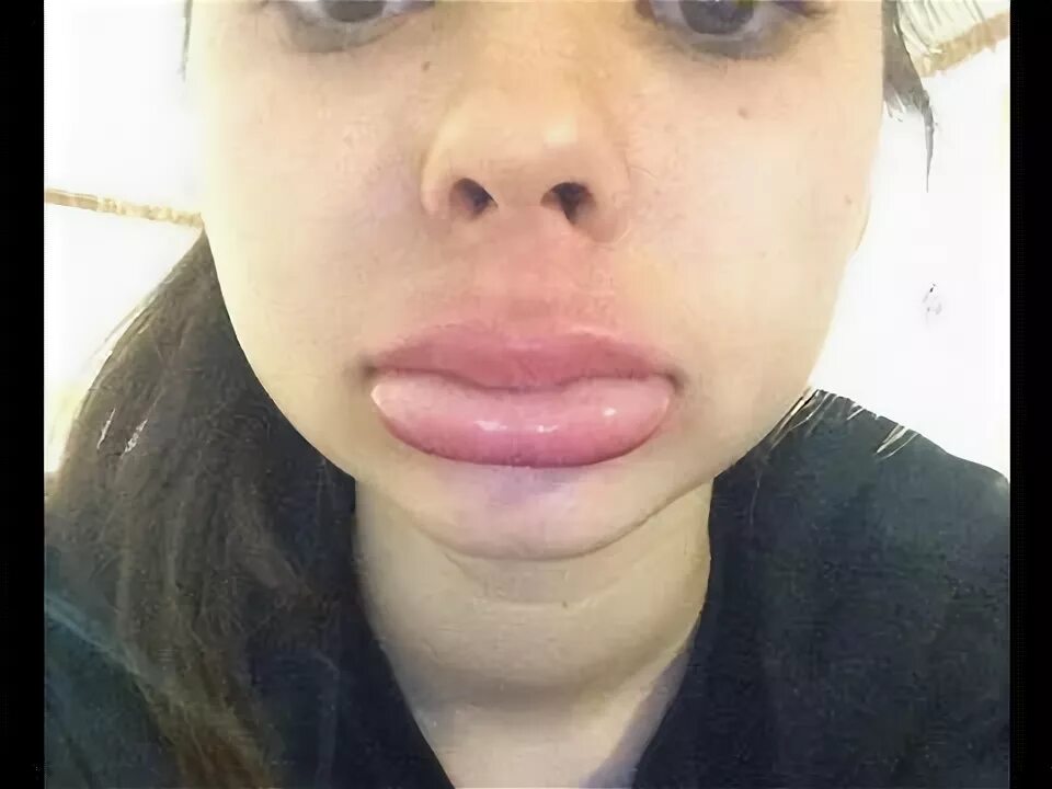 Нижняя губа опухла фото "Kylie Jenner Challenge" Kylie Jenner Challenge Makes White Girls Look Black - Y