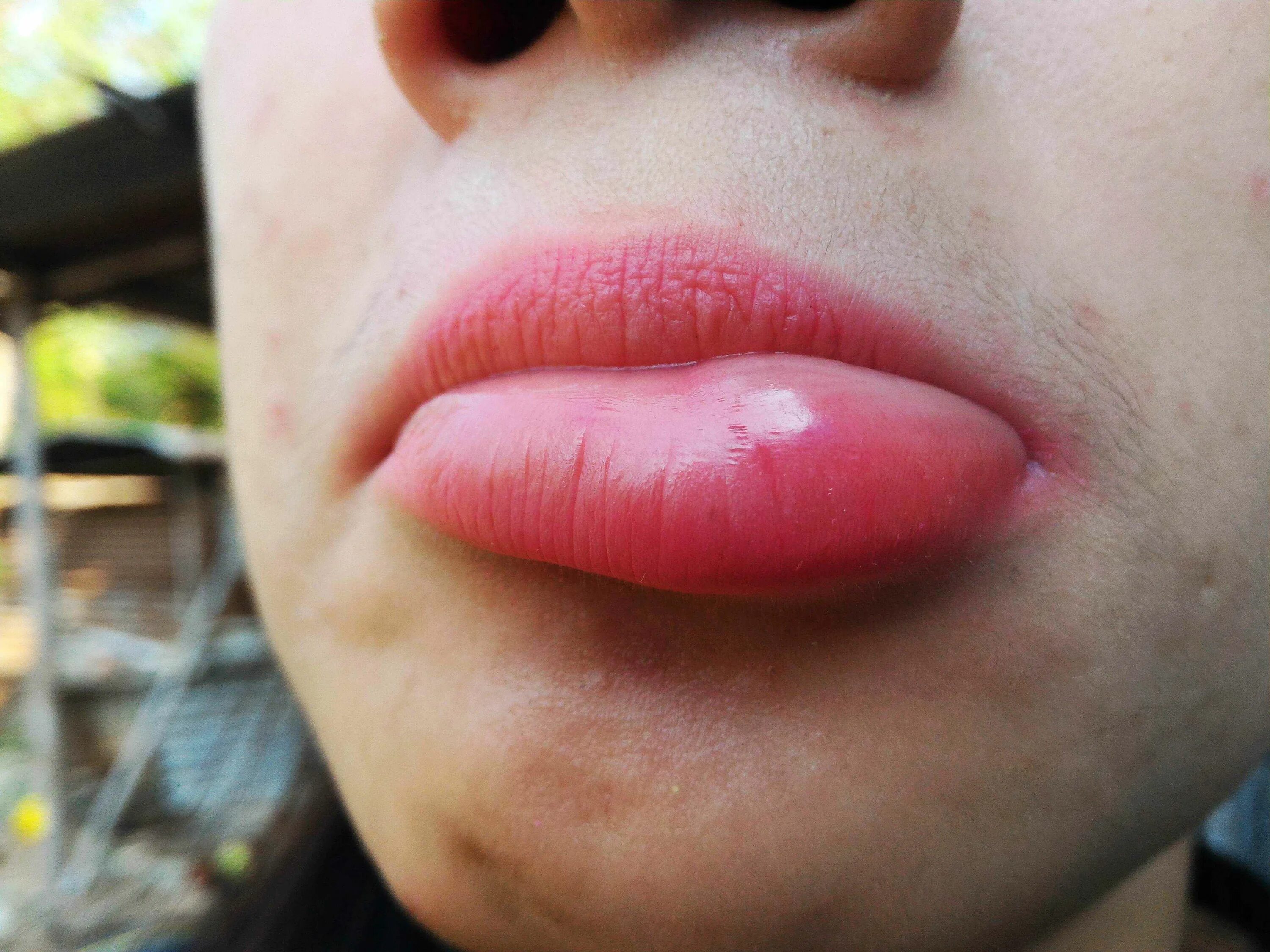 Нижняя губа опухла фото Home Remedies: Stung by a bee - Mayo Clinic News Network