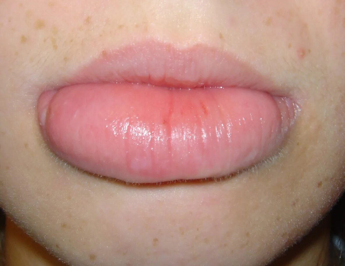 Нижняя губа опухла фото Chronic, progressive enlargement of the lower lip in a healthy girl
