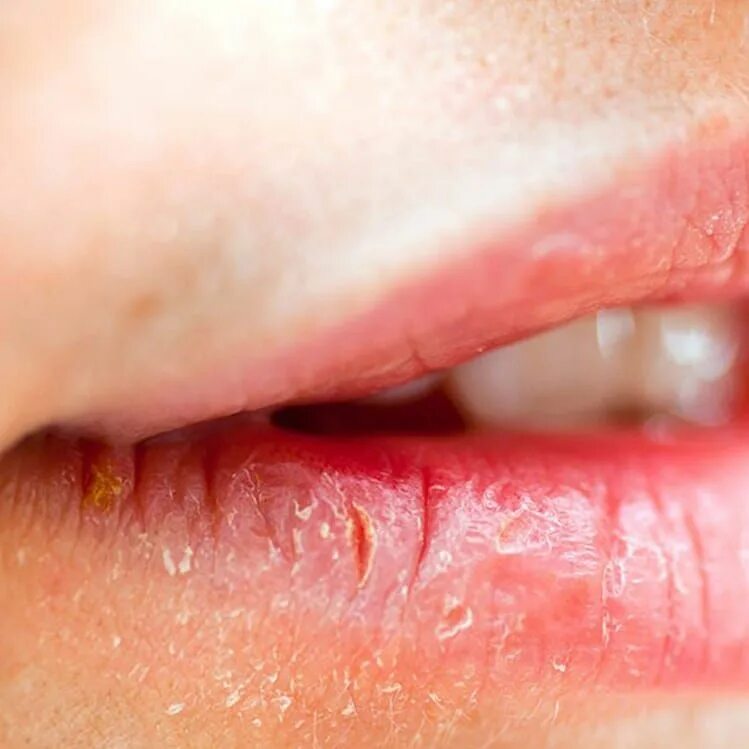 Нижняя губа внутри фото 10 ideas económicas para una boda en la playa Tips de maquillaje, Labios secos, 