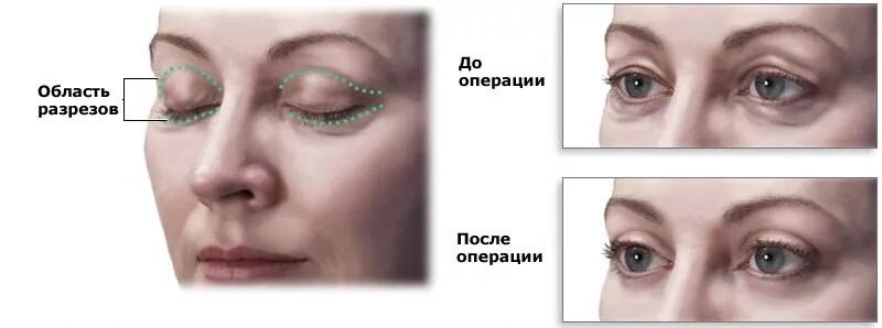 Нижняя и верхняя блефаропластика фото Блефаропластика