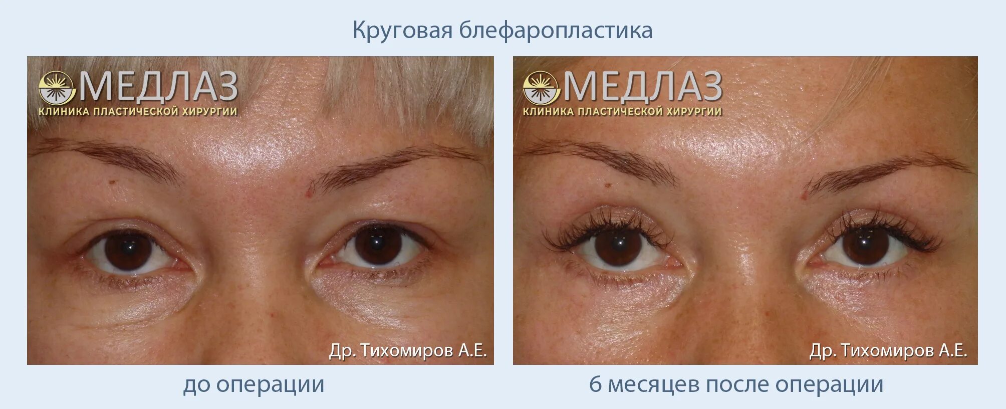 Нижняя и верхняя блефаропластика фото Круговая блефаропластика. Работы доктора Тихомирова А.Е. - МедЛаз