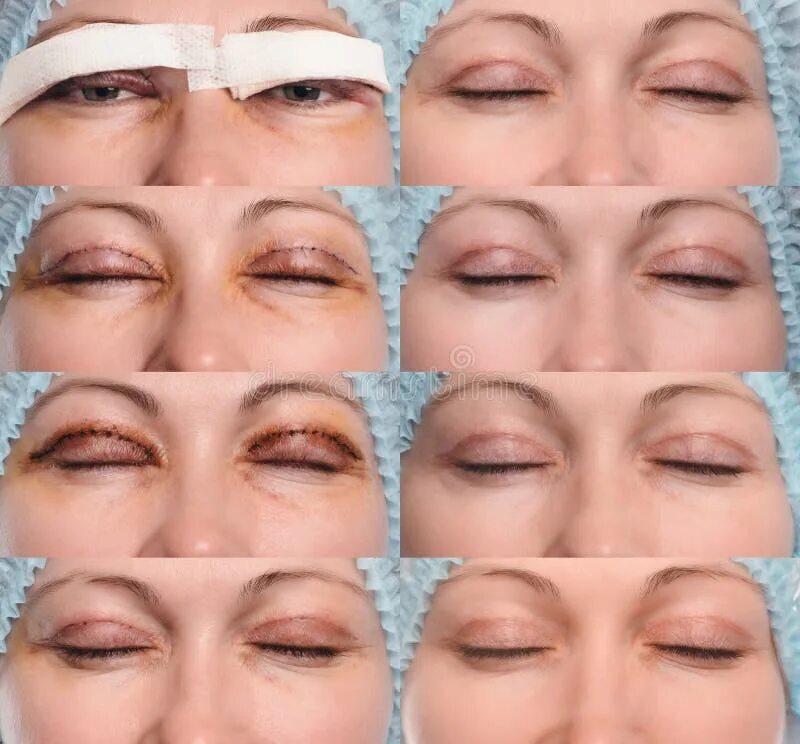 Нижняя и верхняя блефаропластика фото Blepharoplasty of the Upper Eyelid. Stock Image - Image of close, care: 89729957