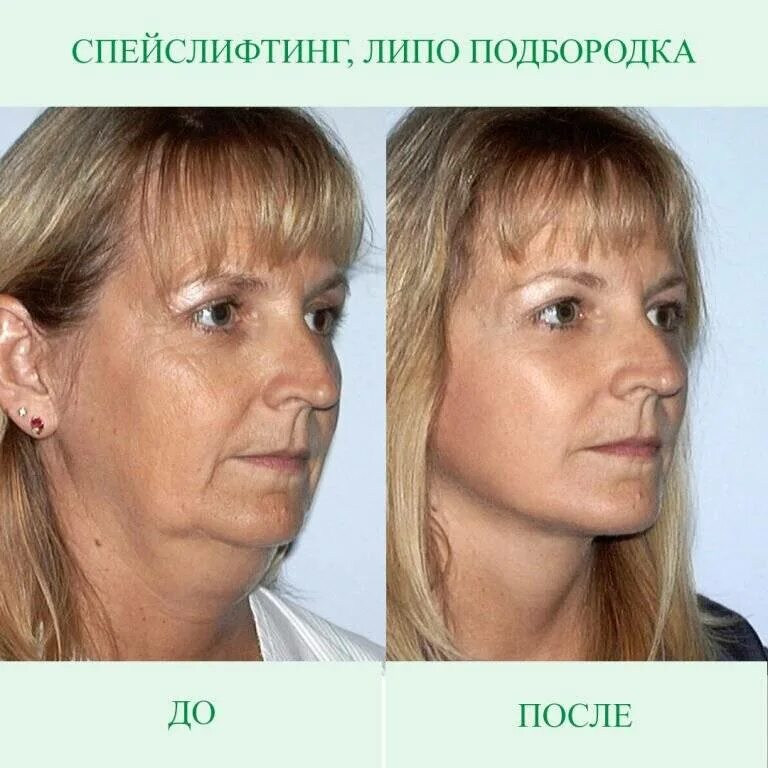 Нижняя подтяжка лица фото Подтяжка нижней трети лица: что такое хирургический и эндоскопический фейслифтин