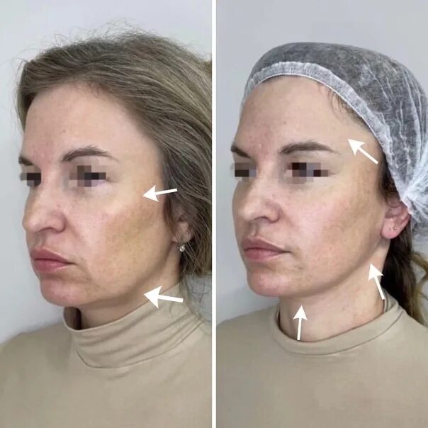 Нижняя треть лица фото This patient was performed temporal lifting + lifting oval and neck. As a result
