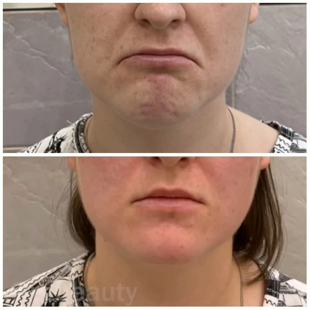 Нижняя треть лица фото Что может ботокс в нижней трети лица - vzbeauty.ru
