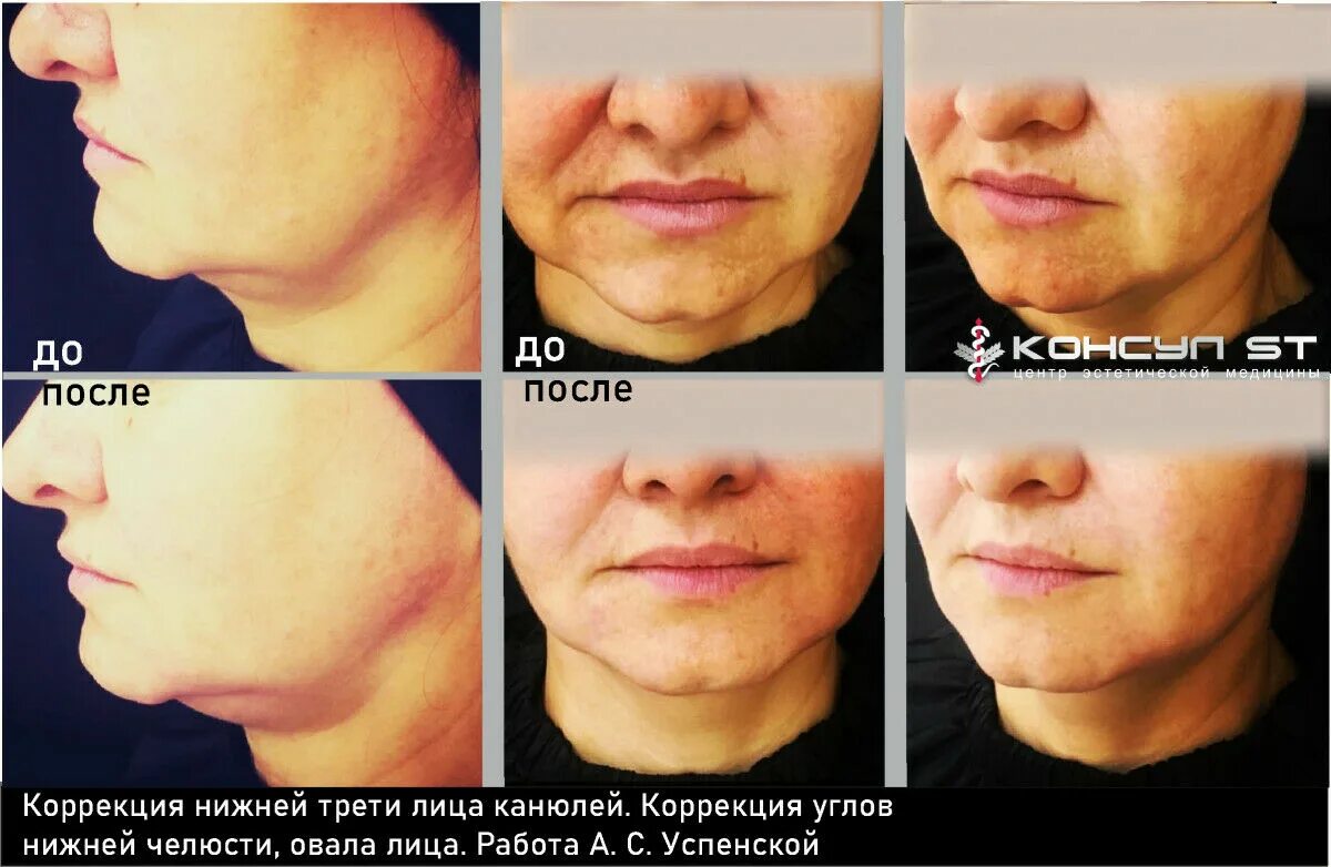 Нижняя треть лица фото Земное притяжение - Центр эстетической медицины Консул-ST Нижний Тагил