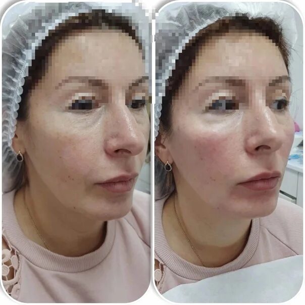 Нижняя треть лица фото Нижняя треть лица процедуры