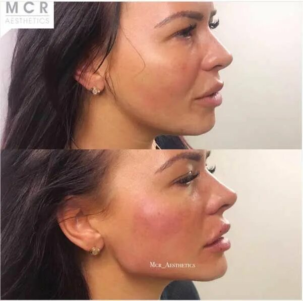 Нижняя треть лица фото How to Use Chin Fillers to give Angulairity and a better Jawline to a Round Face