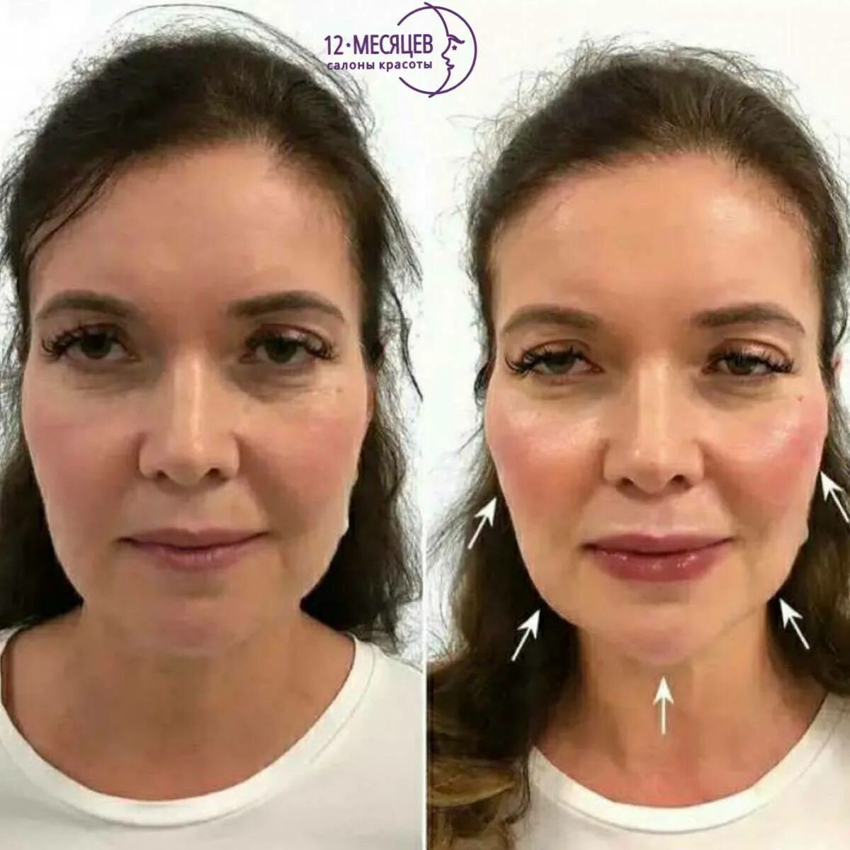 Нижняя треть лица фото SMAS-лифтинг ❤ Смас лифтинг