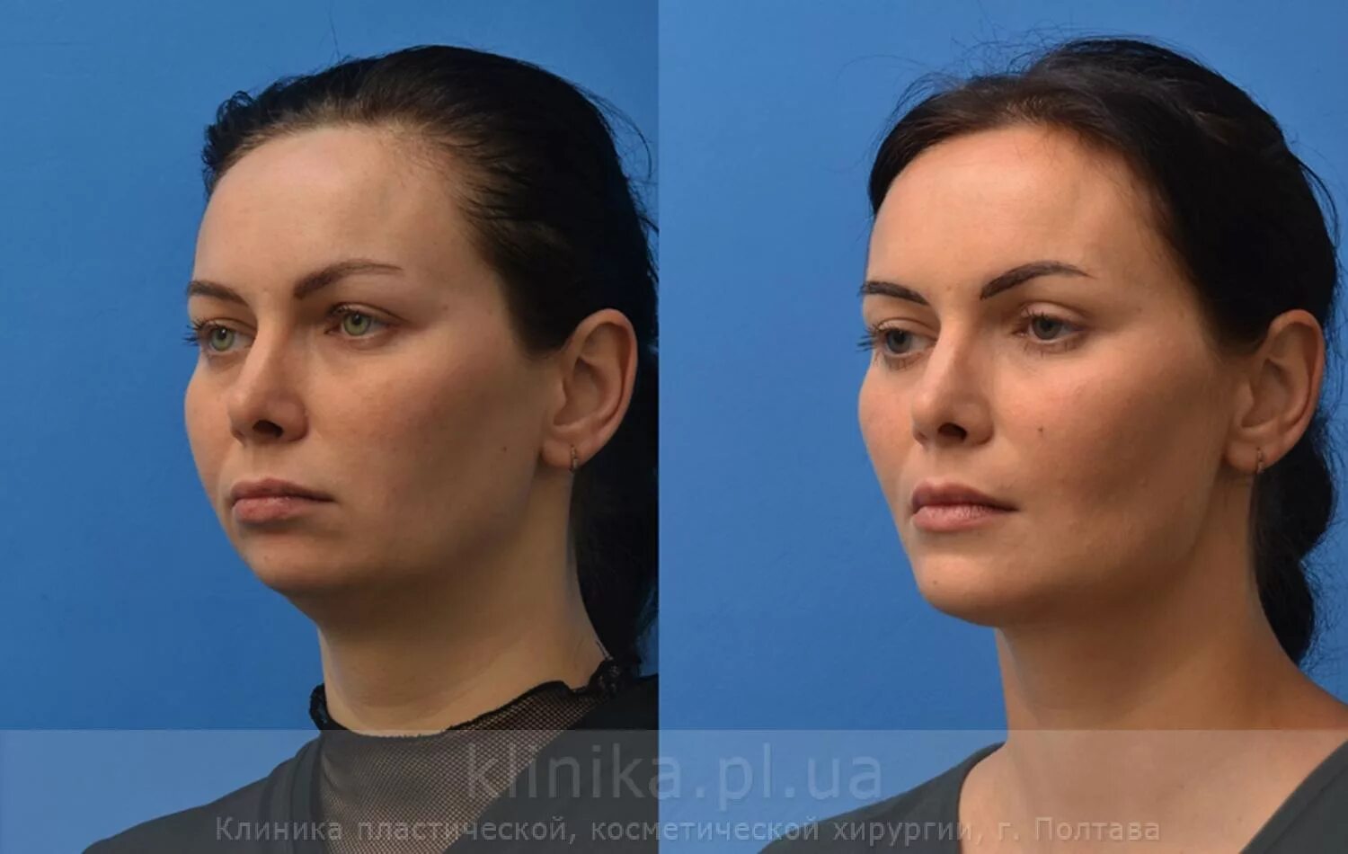 Нижняя треть лица фото ᐉ Фото до и после - установка импланта подбородка, фотографии до и после операци