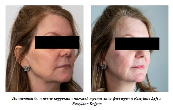 Нижняя треть лица фото до после Инъекции филлеров для коррекции линии нижней челюсти и подбородка: случай из пра