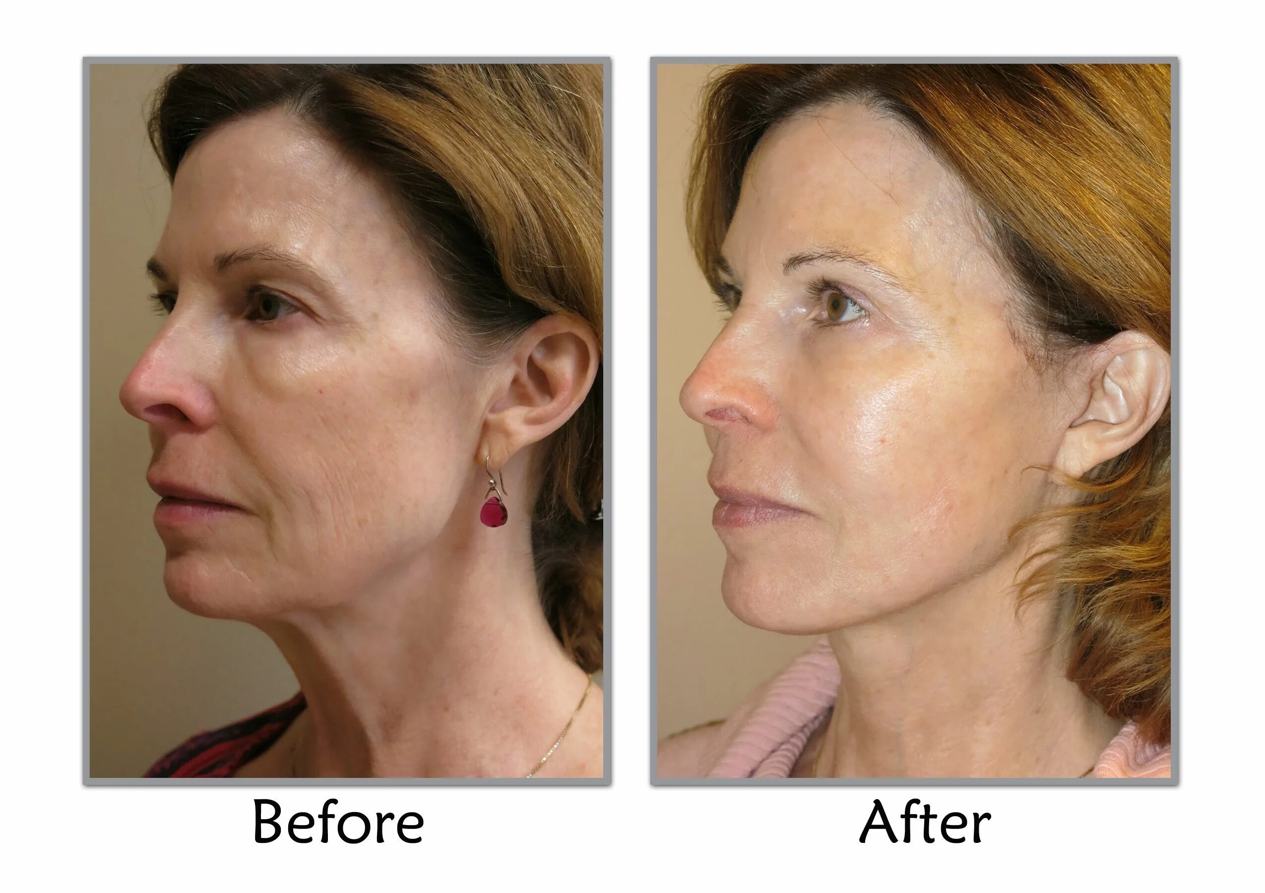 Нижняя треть лица фото до после NYC Midtown Plastic Surgery Long Island Breast Implants Huntington Face lift sur