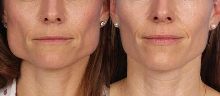Нижняя треть лица фото до после Botox Newton MA - Best Botox Fillers - VISAGE SCULPTURE Eczacı, Cilt bakımı, Cil