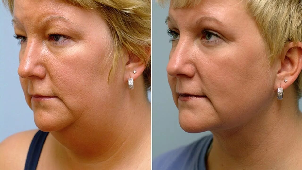 Нижняя треть лица фото до после Gıdı Liposuction Ameliyatı - YouTube