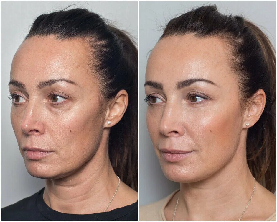 Нижняя треть лица фото до после Lispa, beauty salon, Подольск, Большая Зелёновская улица, 58 - Yandex Maps