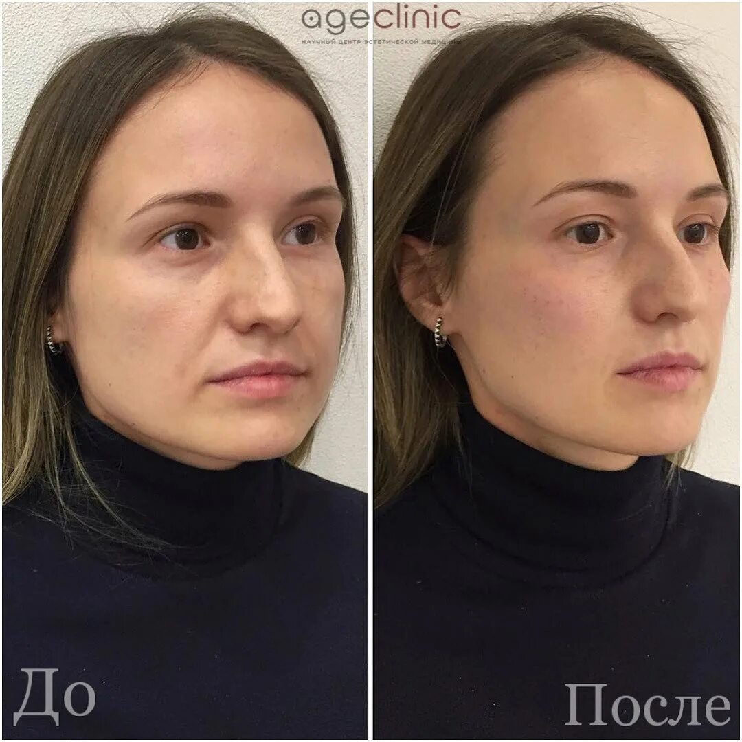 Нижняя треть лица фото до после Контурная пластика лица Цена в Москве Age Clinic