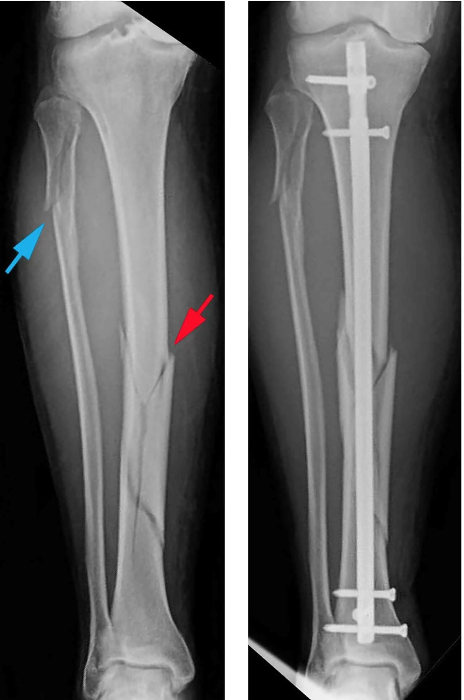 Нижняя треть малоберцовой кости фото Spiral fracture definition, causes, symptoms, treatment & recovery time