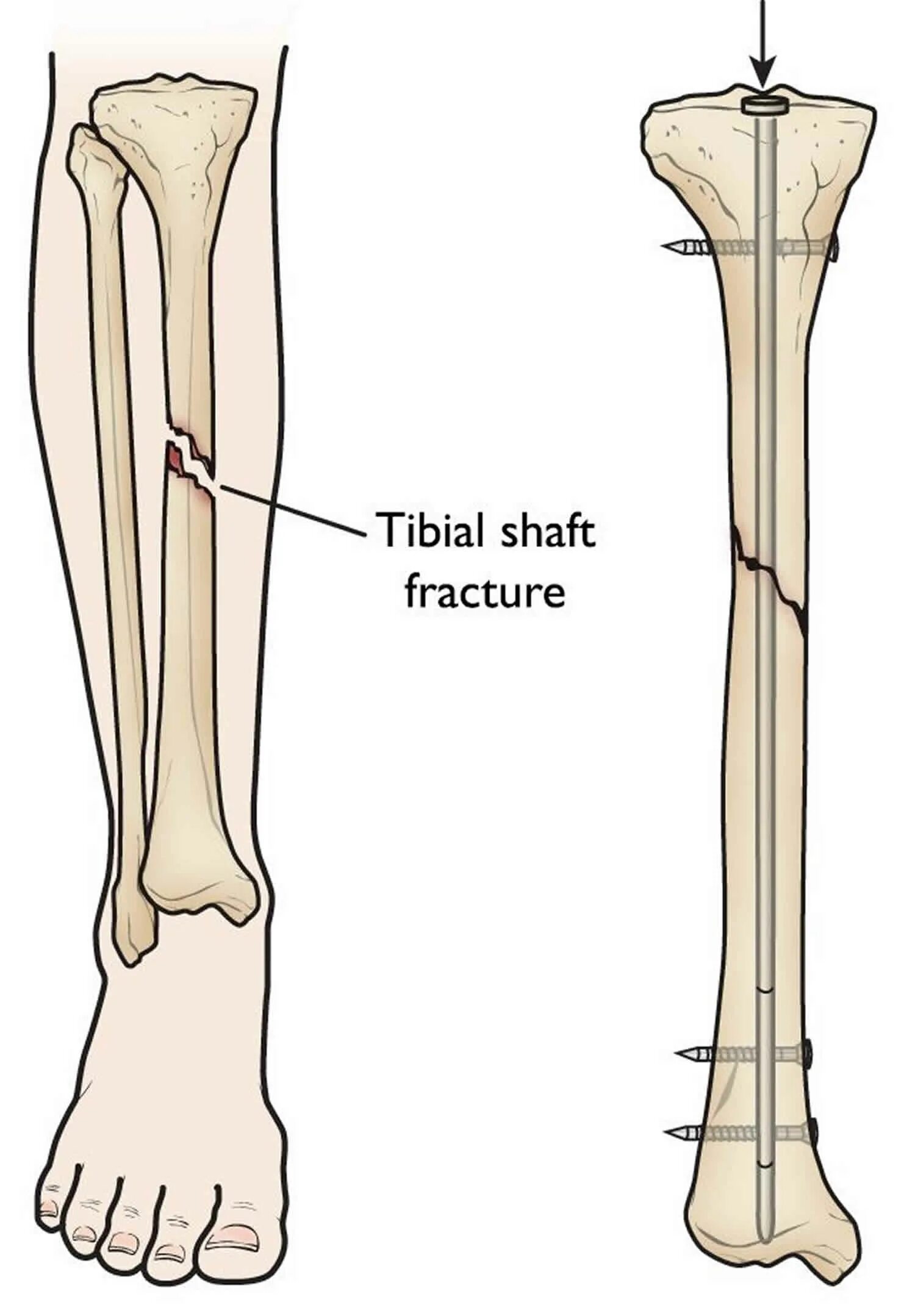Нижняя треть малоберцовой кости фото Broken Bone Drawing - Printable Learn Templates
