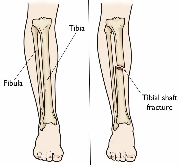 Нижняя треть малоберцовой кости фото Image result for tibia