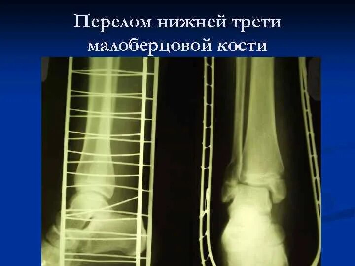 Нижняя треть малоберцовой кости фото Левой малоберцовой кости: найдено 84 изображений
