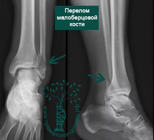 Нижняя треть малоберцовой кости фото Перелом голеностопного сустава, травмы голеностопного сустава