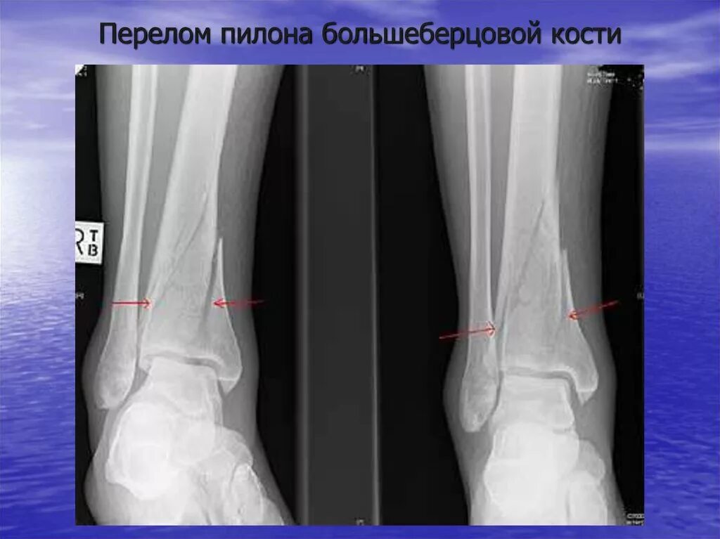Нижняя треть малоберцовой кости фото Перелом большеберцовой
