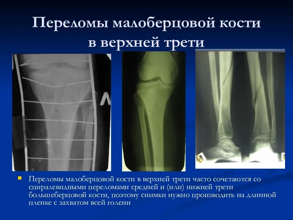 Нижняя треть малоберцовой кости фото Закрытый перелом нижней трети малоберцовой кости