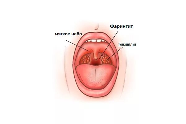Острый фарингит фото горла у взрослого Игорь Атрощенко Диагностика и лечение тонзиллитов, ларингитов и фарингитов (2020