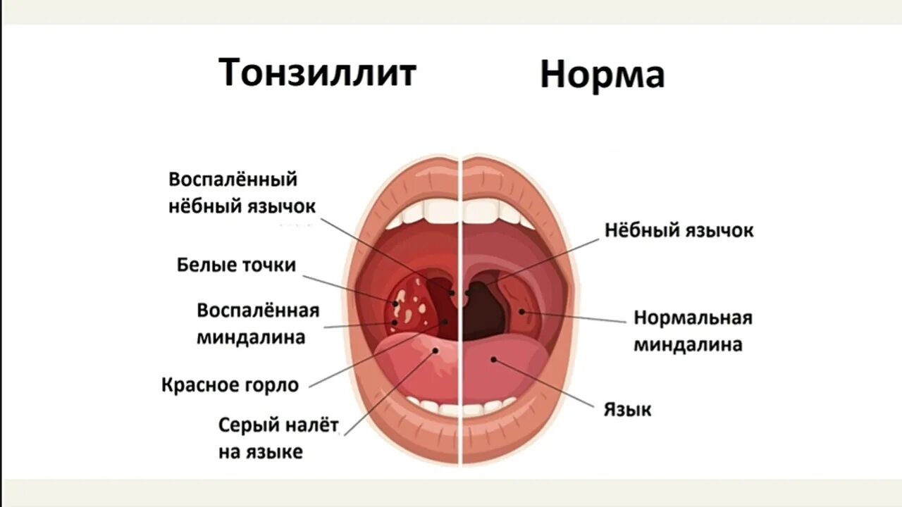 Острый фарингит фото горла у взрослого "Стрептококковая инфекция. Этиология" - YouTube