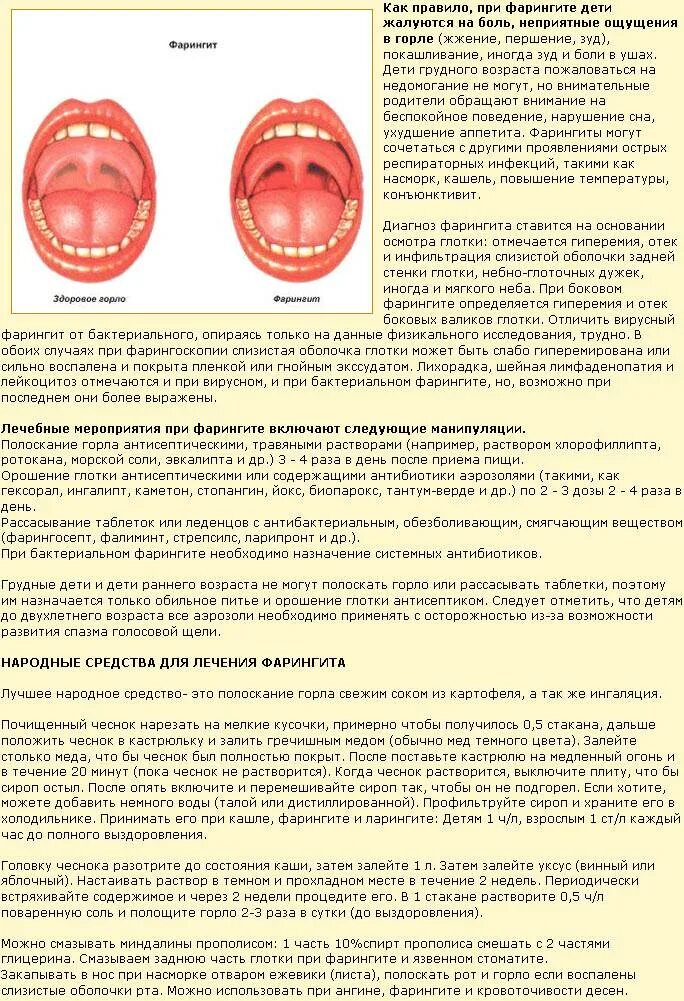 Острый фарингит фото горла у взрослого Герпетическая ангина (фото) и ее лечение у детей и взрослых
