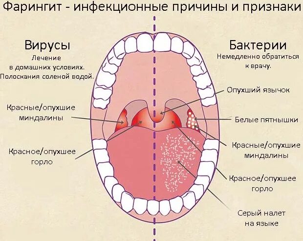 Острый фарингит фото горла у взрослого Фарингит: симптомы, причины возникновения и способы лечения заболевания