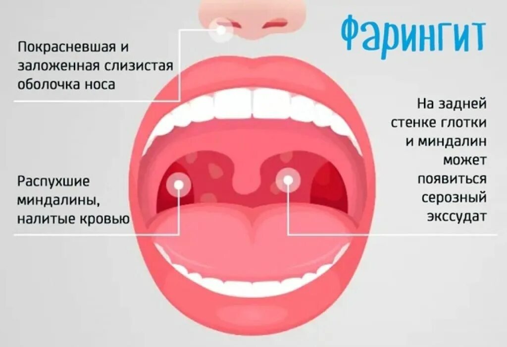 Острый фарингит лечение у взрослых симптомы фото Фарингит: причины возникновения, описание симптомов, диагностика и лечение - MED